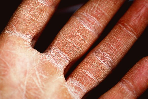 What Are the Best Practices for Managing Eczema in the UK's Humid Climate?